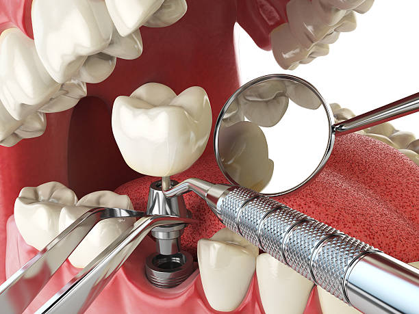 Best Emergency Treatment for Dental Infections or Abscesses in Moscow, PA