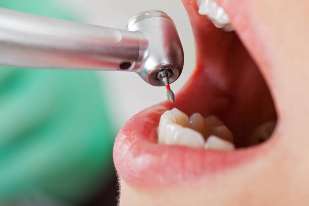 Best Emergency Tooth Extraction in Moscow, PA
